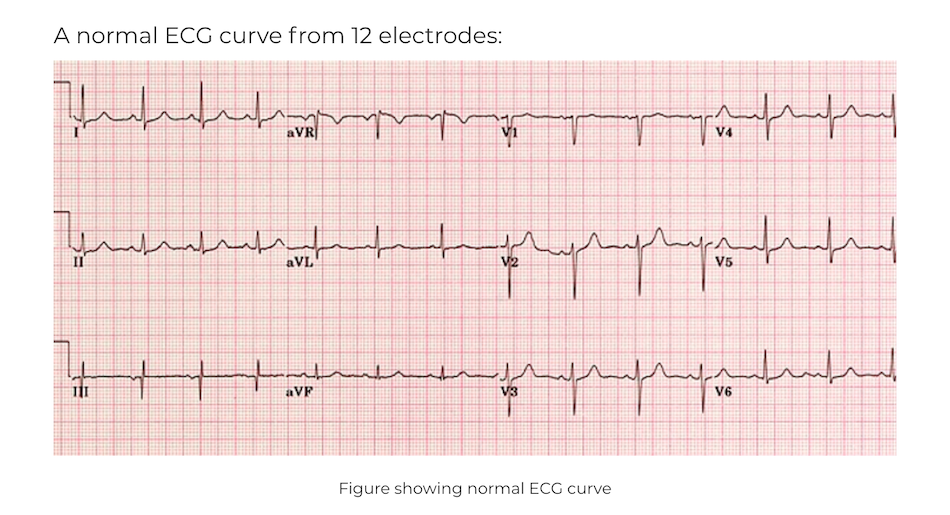 Random EKG reading